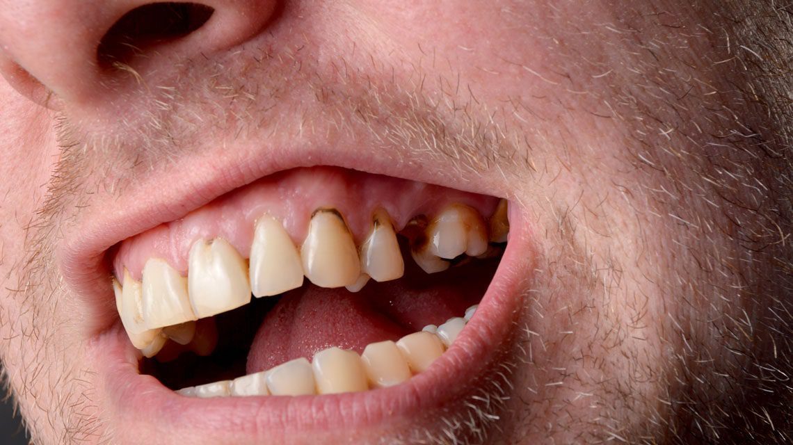 آیا از دست دادن مینای دندان مشکلی جدی است؟