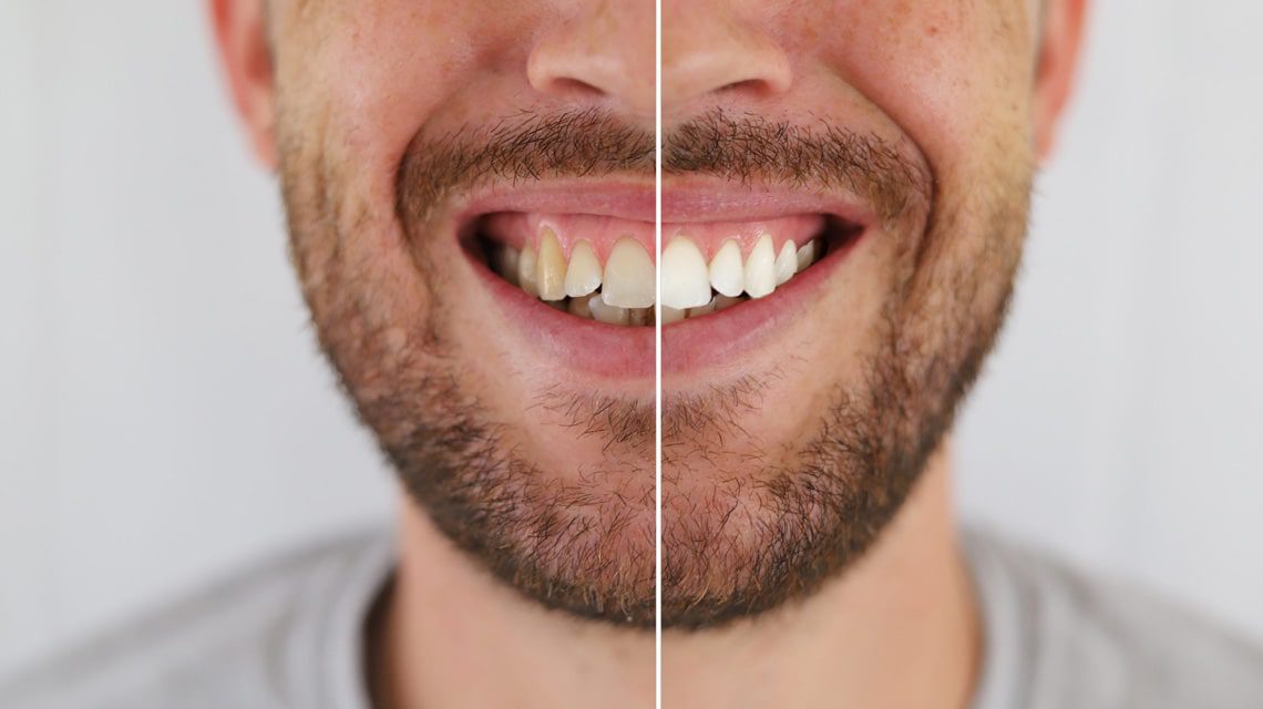 معرفی راه های سفید کردن دندان ها