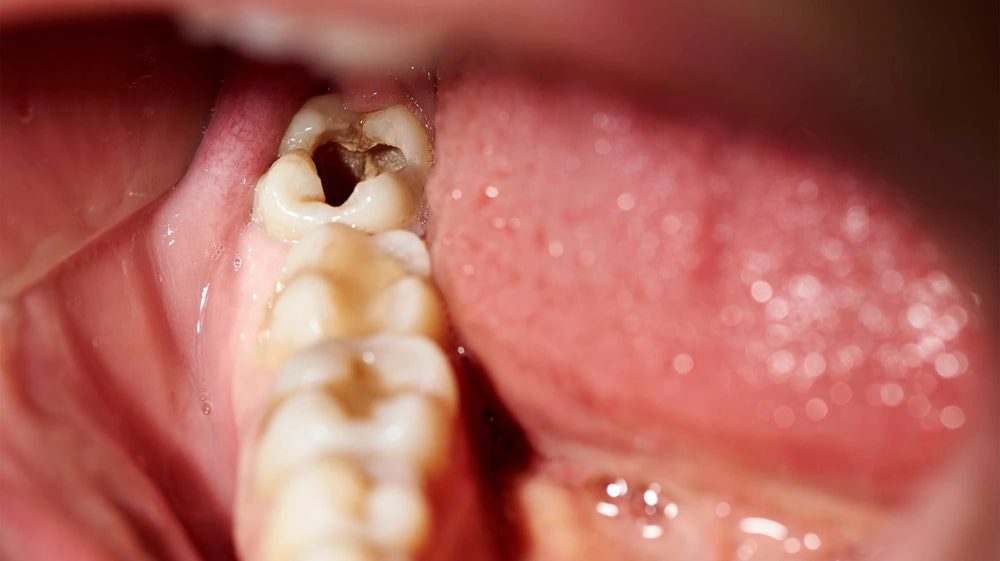 اطلاع از وجود حفره در دندان ها چگونه است؟