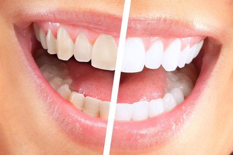 روش هایی برای سفید نگه داشتن دندان ها