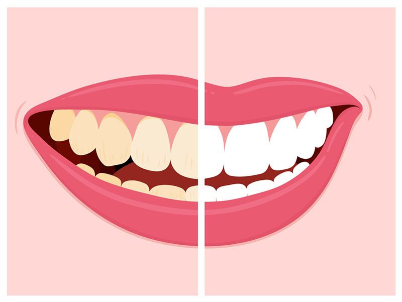 teeth staining 1 پاسخ به سوالات شما در مورد لکه دندان