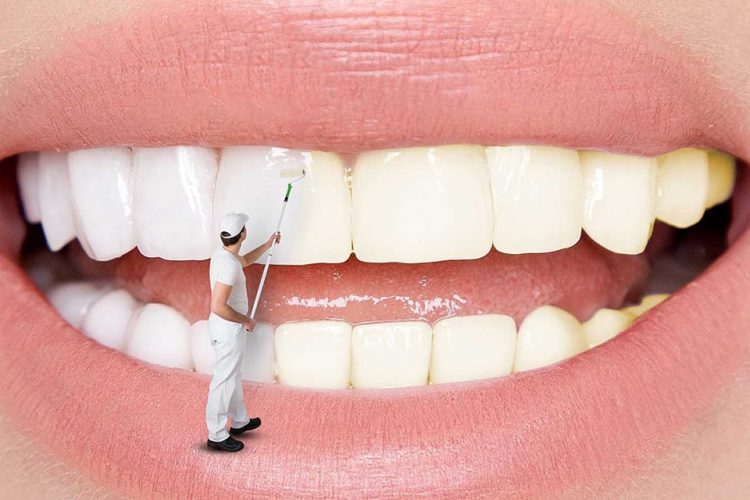 پاسخ به سوالات شما در مورد لکه دندان