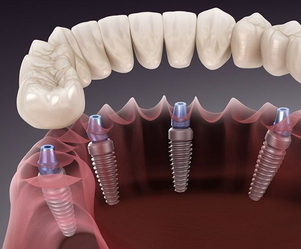 نقض پنج تفکر اشتباه در مورد ایمپلنت دندان