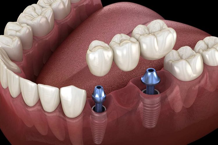 نقض پنج تفکر اشتباه در مورد ایمپلنت دندان