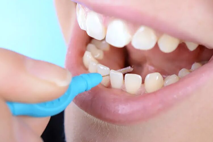 تمیز کردن بین دندان