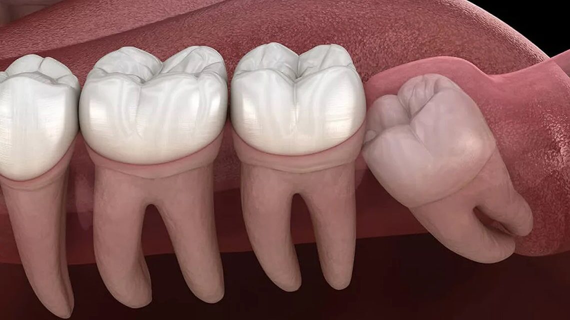 8 نشانه که به شما می‌گوید زمان کشیدن دندان عقل است