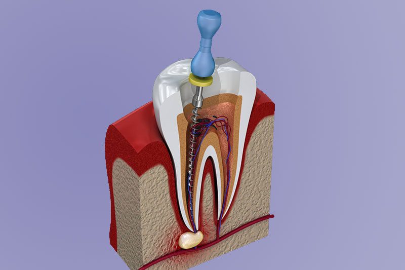 چگونه بفهمید که به درمان ریشه دندان نیاز دارید
