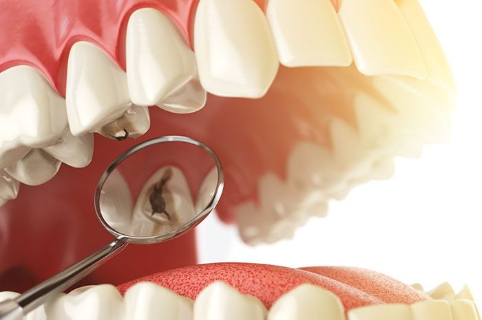 علائم نشان دهنده پوسیدگی دندان