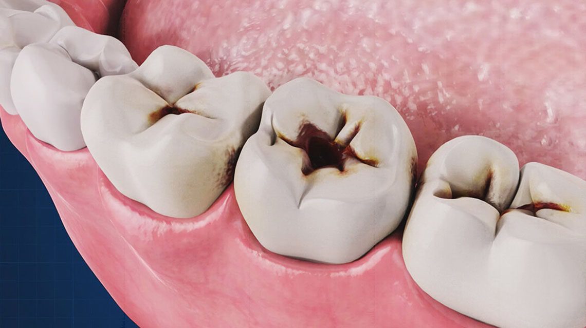 علائم نشان دهنده پوسیدگی دندان