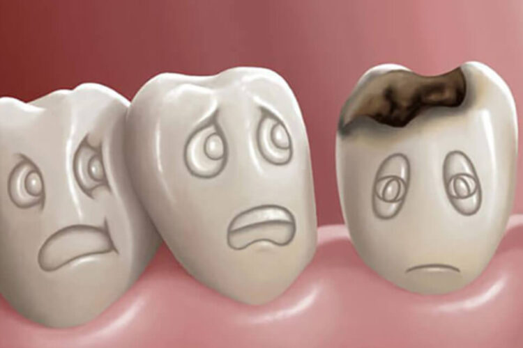 نحوه تشخیص و درمان پوسیدگی و حفره دندان
