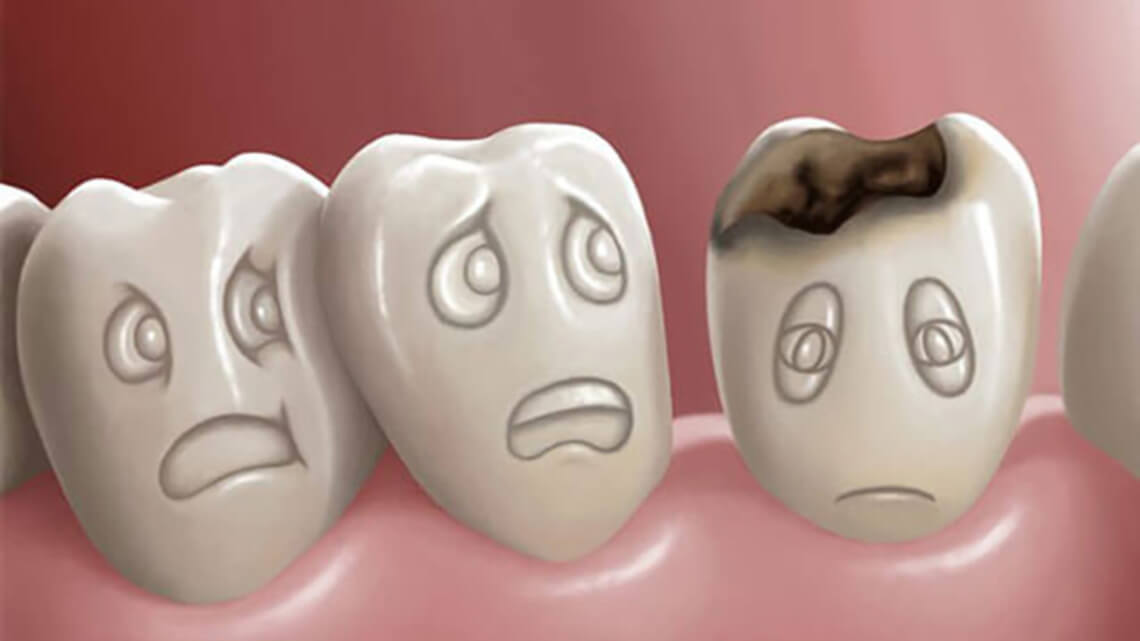 نحوه تشخیص و درمان پوسیدگی و حفره دندان