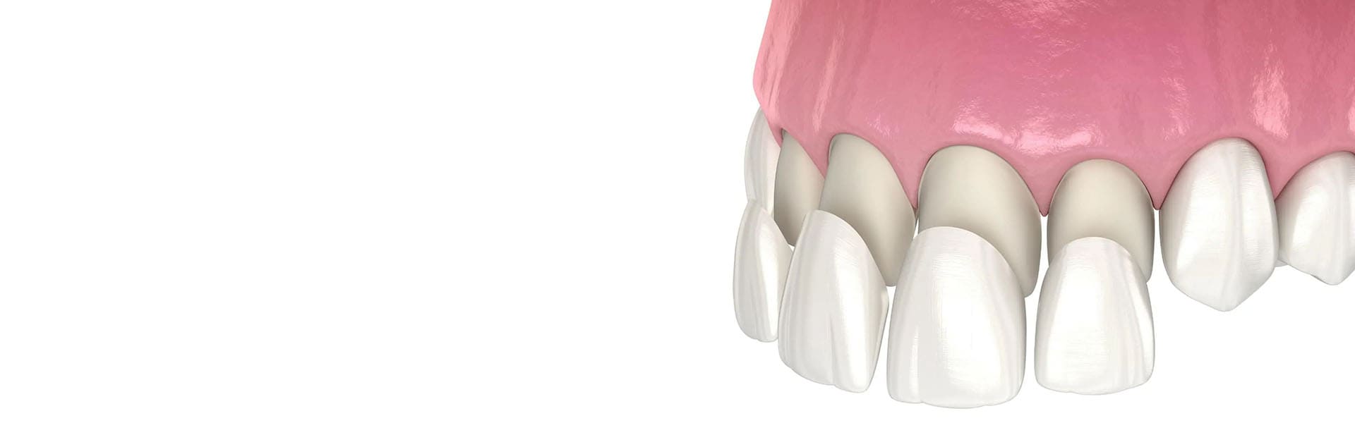 باندینگ دندان - پیوند دندان