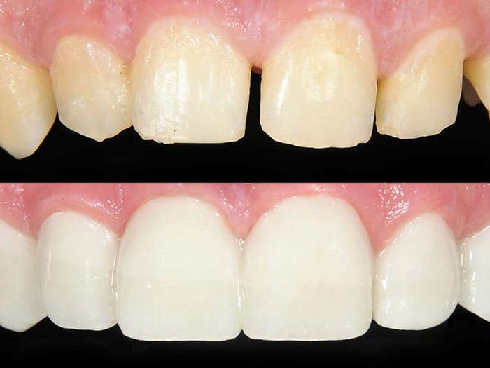 باندینگ دندان - پیوند دندان