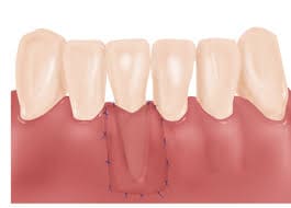 پیوند لثه در دندانپزشکی
