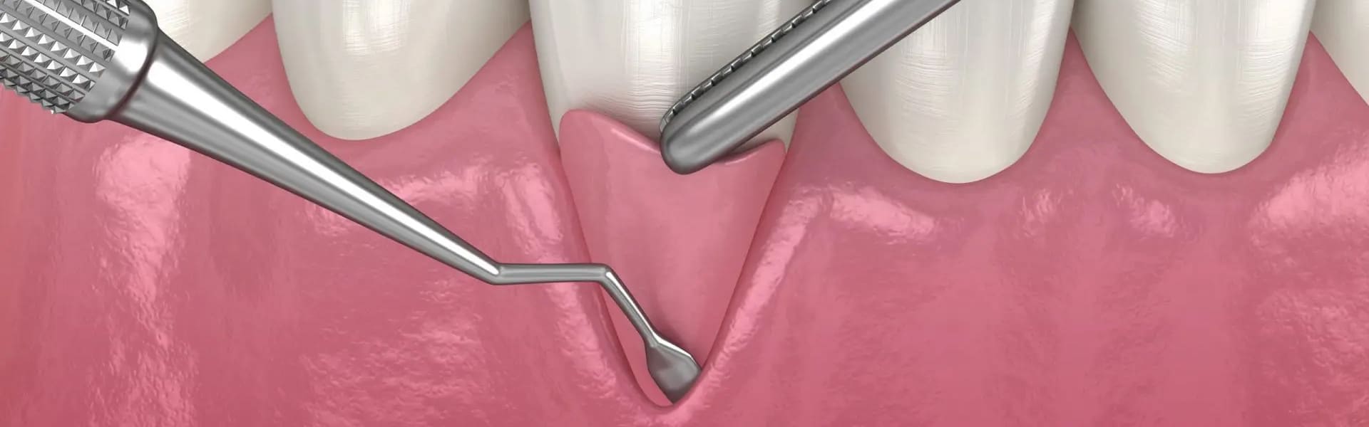 پیوند لثه در دندانپزشکی