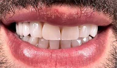 Dental crowns min معرض الابتسامة