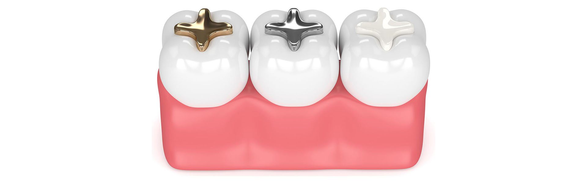 dental filling in sepident.com 2 پر کردن دندان