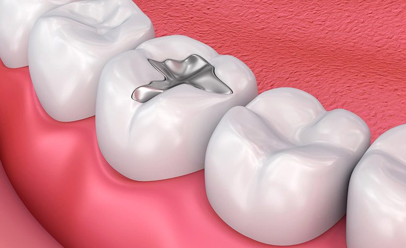 dental filling in sepident.com 3 پر کردن دندان