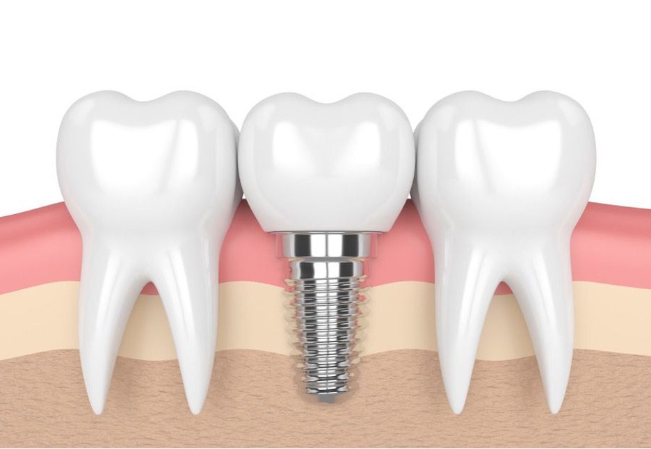 ایمپلنت دندان انواع ایمپلنت دندان معرفی و آشنایی با آنها