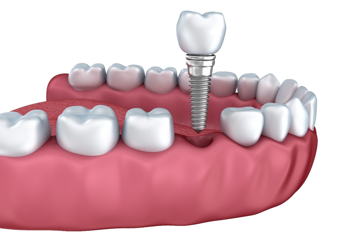 شرح ایمپلنت دندان
