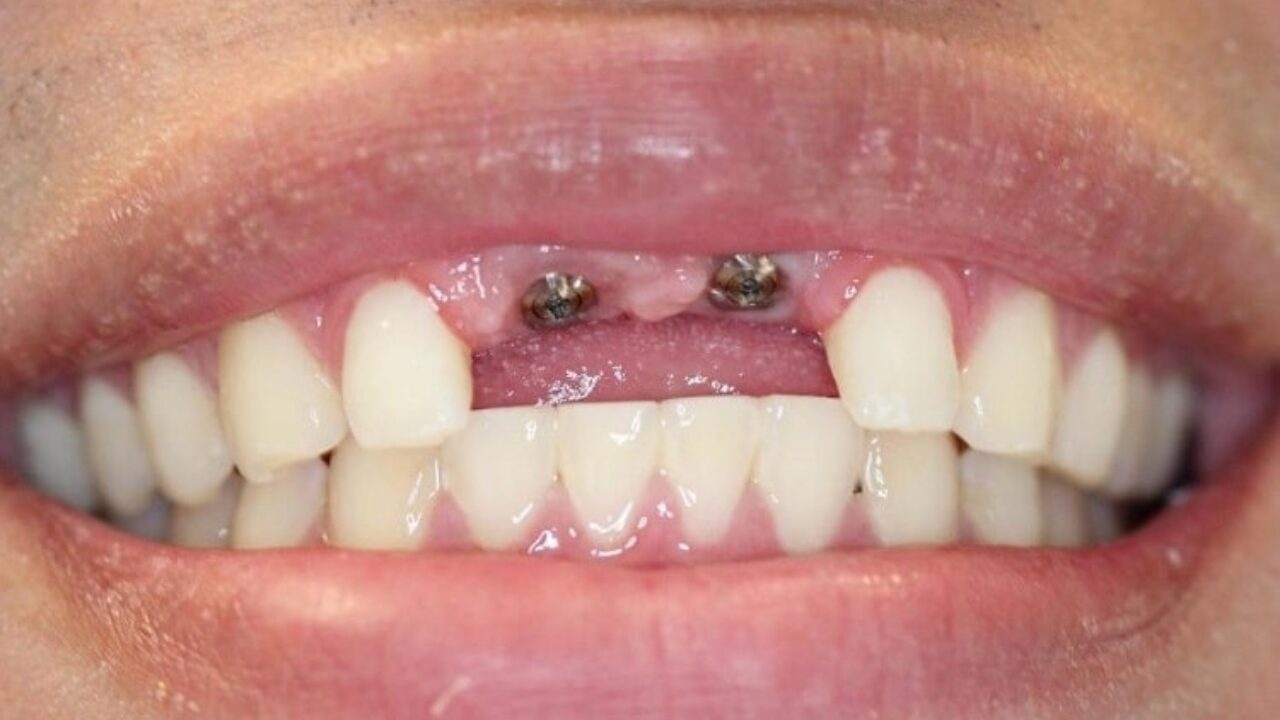 ایمپلنت دندان های جلو