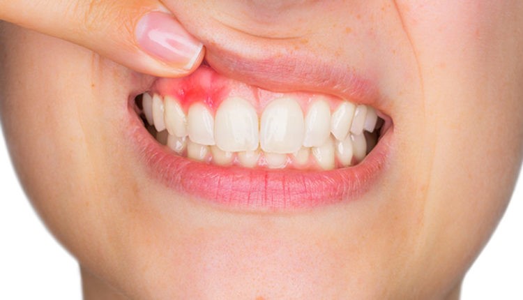 علائم آبسه دندان و بهترین روش درمان آن