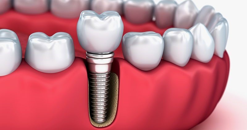 مراحل ایمپلنت دندان فک بالا و پایین