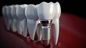 قبل از ایمپلنت دندان چه اقداماتی را باید انجام داد؟