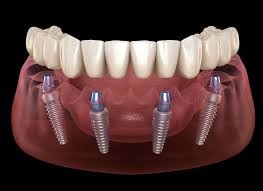 پیچ های ایمپلنت دندان